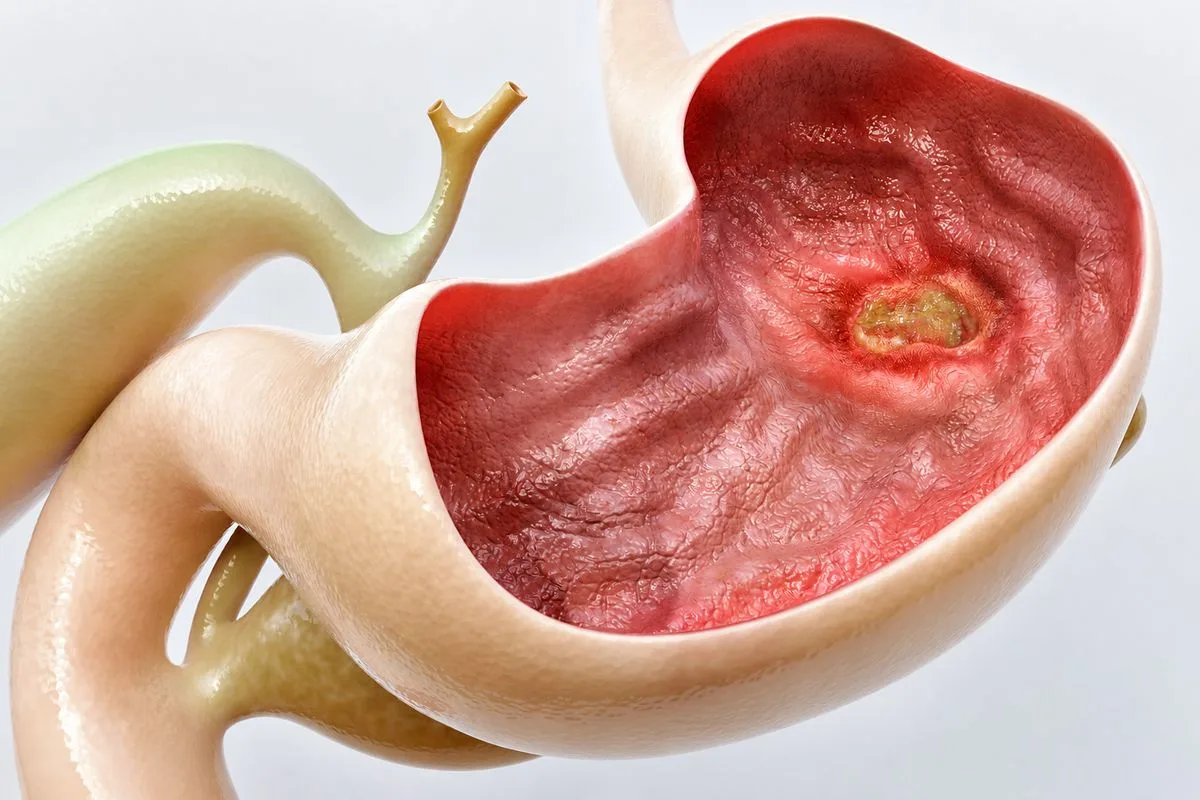 Eden Koo IBS Study ACG: Enzyme Supplement Cuts Symptom Severity in 4 Weeks